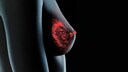 Wenn ein Tumor streut, l&ouml;sen sich Krebszellen vom Ursprungstumor und gelangen &uuml;ber Blut oder Lymphe in andere Organe