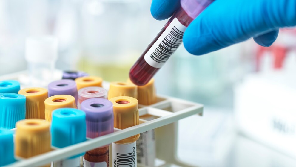 Frühtest für Multiple Sklerose