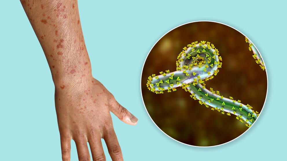 Symptome einer Infektion mit dem Marburg-Virus