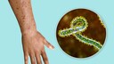 Symptome einer Infektion mit dem Marburg-Virus