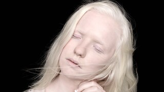 Menschen mit Albinismus haben einen Gendefekt, der die Melaninproduktion hemmt – ihre Haut, Haare und Augen sind daher ungewöhnlich hell