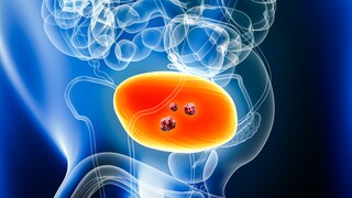Verdacht auf unterschätzten Auslöser: Eine neue Studie bringt ein lange bekanntes Virus mit Blasenkrebs in Verbindung.