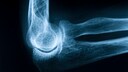 Methode, die Knochenschwund umkehren soll