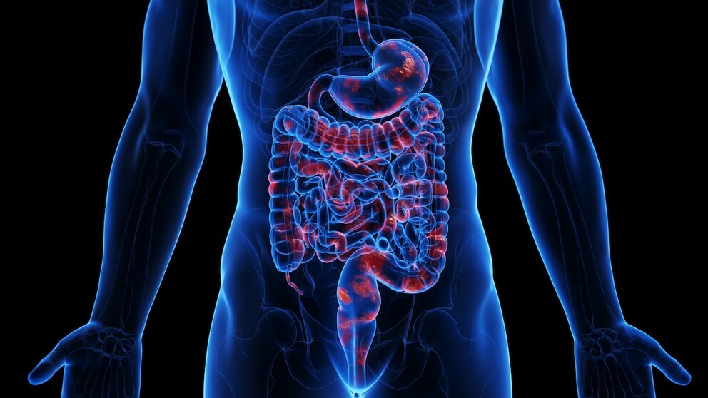 Der Darm bei Morbus Crohn