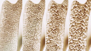 Veränderung der Knochenstruktur bei Osteoporose
