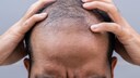 Es wurde eine bisher unbekannte Ursache f&uuml;r Haarausfall identifiziert