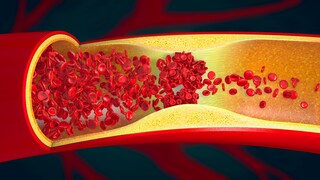 Erhöhte Cholesterinwerte über lange Zeit können zu Plaque in den Arterien führen