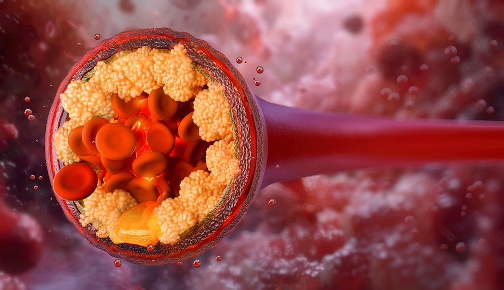 &Uuml;berraschender Faktor, der offenbar die Cholesterinwerte beeinflusst