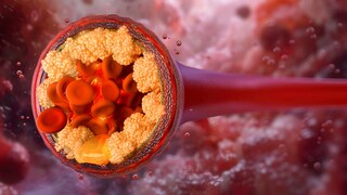 Cholesterin und Straßenlärm – Studie zeigt Verbindung