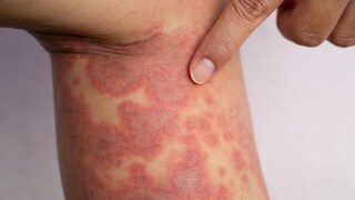 Dermatomyositis ist eine seltene Autoimmunerkrankung, die bei Kindern Haut und Muskulatur betreffen kann.