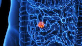 Eine kanadische Studie prüft, ob Intervallfasten Symptome bei Morbus Crohn mildert und Entzündungen senkt.