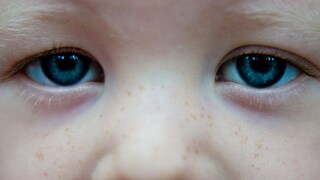 Das häufigste Symptom bei Kindern mit Augenkrebs ist ein weißes Aufleuchten der Pupille bei Blitzlichtfotos.