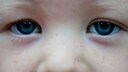 Das h&auml;ufigste Symptom bei Kindern mit Augenkrebs ist ein wei&szlig;es Aufleuchten der Pupille bei Blitzlichtfotos.