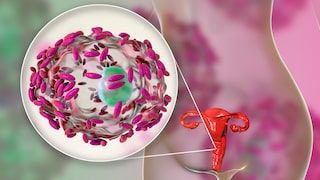 bakterielle Vaginose