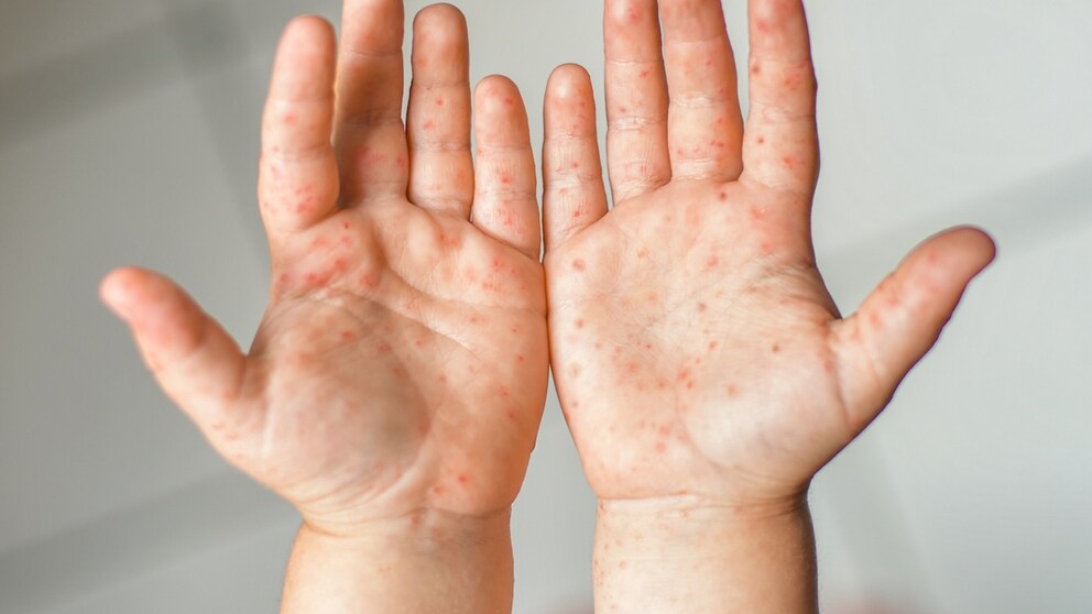 Meningitis B ist in England ausgebrochen und hat zwei Menschen das Leben gekostet.