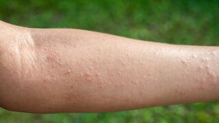 Eine Follikulitis ist eine Entzündung der Haarfollikel, die sich meist durch gerötete, eitrige Pusteln bemerkbar macht.