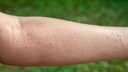 Eine Follikulitis ist eine Entz&uuml;ndung der Haarfollikel, die sich meist durch ger&ouml;tete, eitrige Pusteln bemerkbar macht.