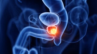 Milch Prostatakrebs