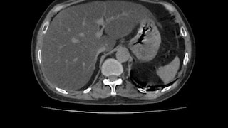 CT einer Fettleber