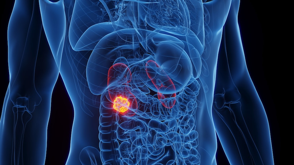 Nierenkrebs ist bei frühzeitiger Diagnose in den meisten Fällen gut therapierbar