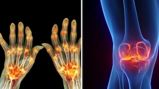 Arthritis und Arthrose unterscheiden sich deutlich. Ursachen, Symptome und typische Beschwerden im Überblick.