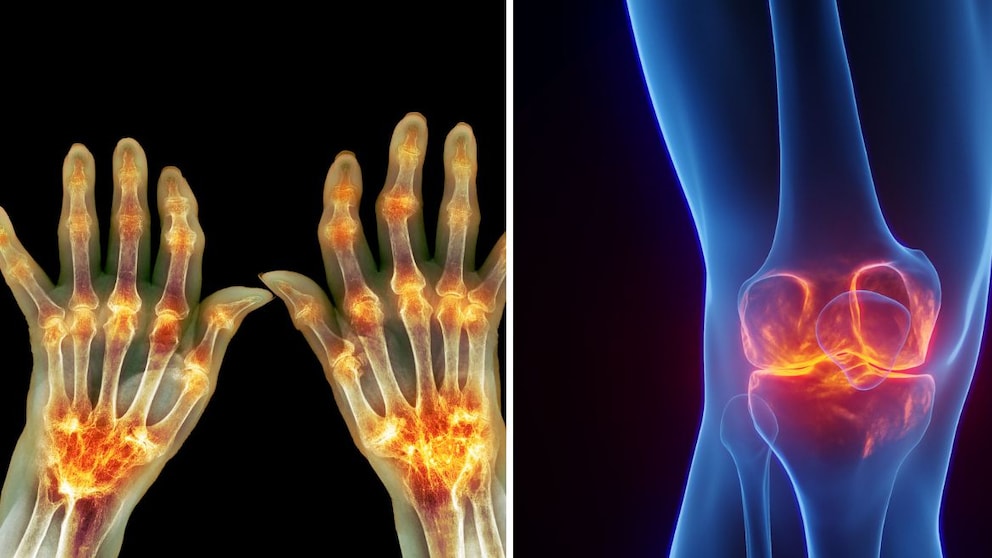 Arthritis und Arthrose unterscheiden sich deutlich. Ursachen, Symptome und typische Beschwerden im Überblick.
