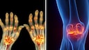 Arthritis und Arthrose unterscheiden sich deutlich. Ursachen, Symptome und typische Beschwerden im &Uuml;berblick.