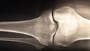 Wie h&auml;ngen die Gesundheit von Knochen und Psyche zusammen?