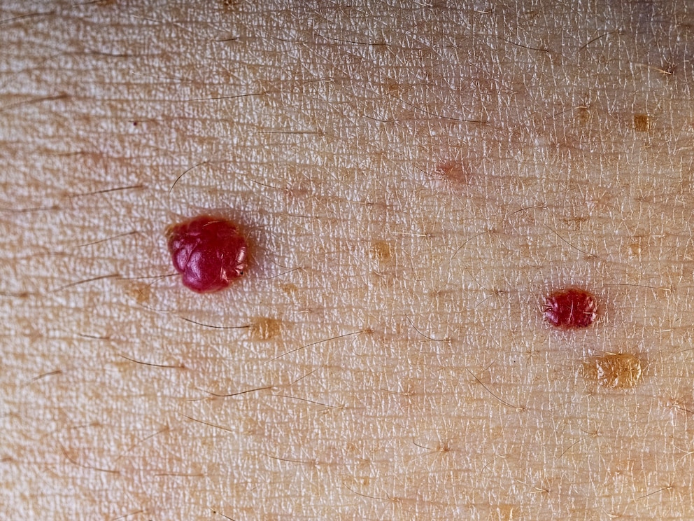 Faszinierend Viele Kleine Rote Punkte Auf Der Haut Fotos