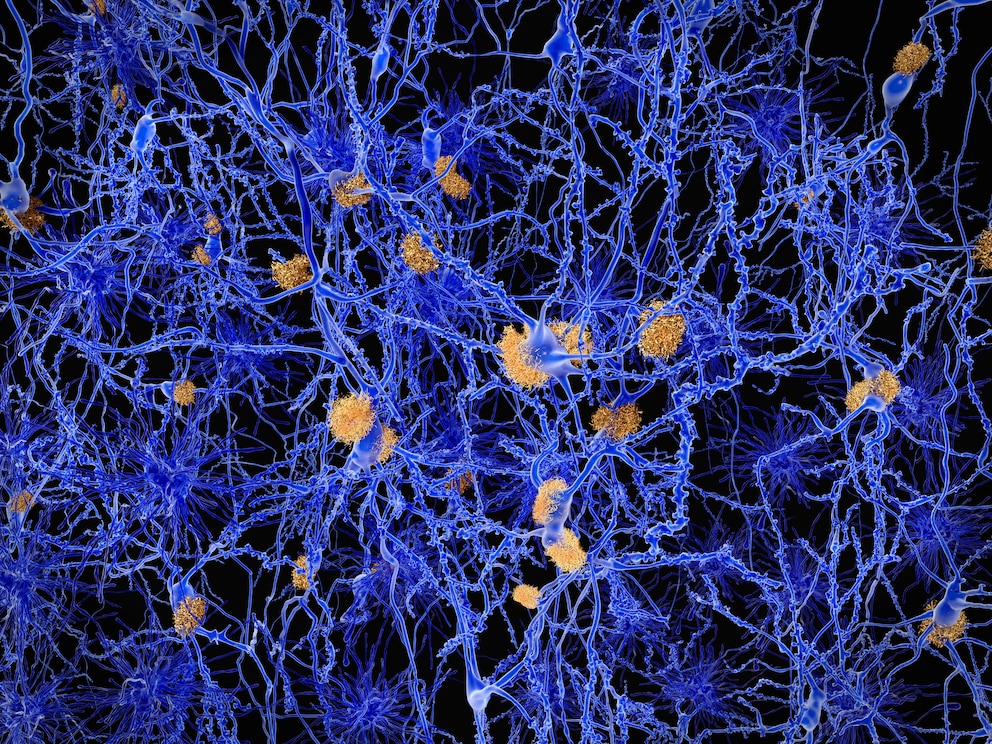 Möglicher Zusammenhang zwischen niedrigem Blutdruck und Alzheimer