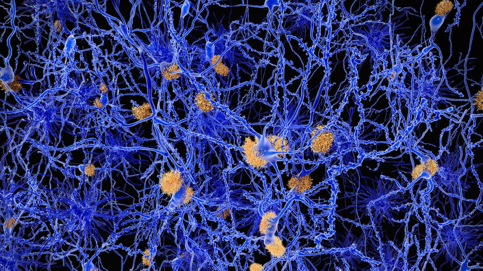 Alzheimer-Krankheit unter dem Mikroskop