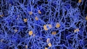 Alzheimer-Krankheit unter dem Mikroskop