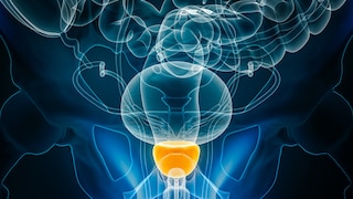 Viele Männer über 75 haben ein Prostatakarzinom, ohne jemals davon zu erfahren, da viele dieser Tumoren nur langsam wachsen und keine Beschwerden verursachen.