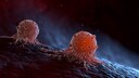Lymphdr&uuml;senkrebs &auml;u&szlig;ert sich durch stark geschwollene Lymphknoten.