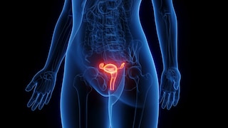 endometriose