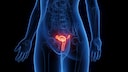 endometriose