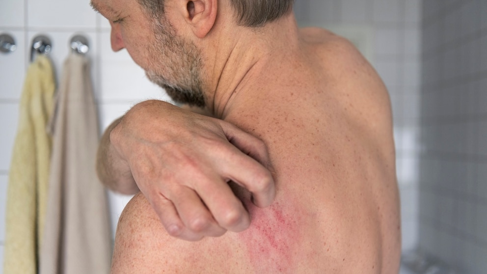 Bestimmte Hautveränderungen können auf die Dermatophilose hindeuten