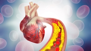 Arteriosklerose