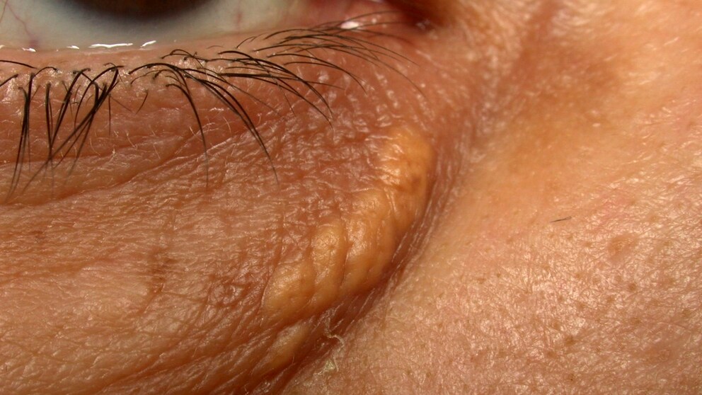 auge