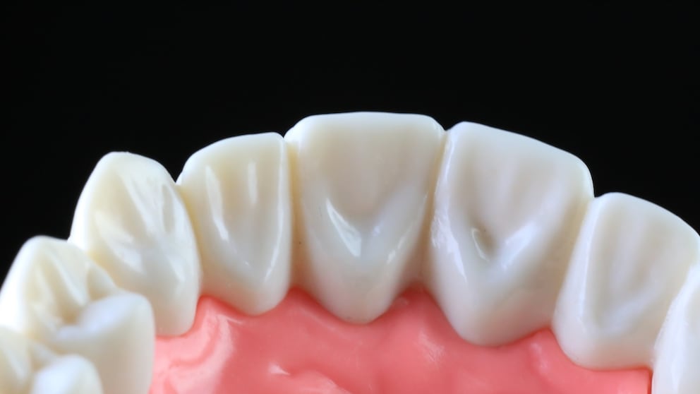 Parodontitis wird im Zusammenhang mit Alzheimer erforscht