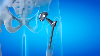 Künstliche Hüften und Knie können winzige Partikel freisetzen. US-Forscher untersuchen nun, ob diese bis ins Gehirn gelangen können