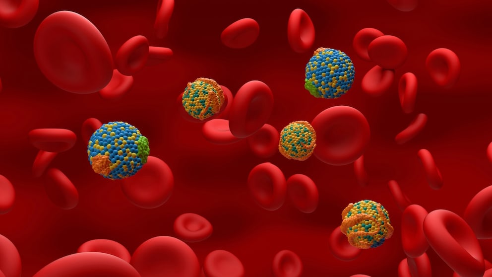 Blutfette haben Einfluss auf Schlaganfall und Herzinfarktrisiko. Insbesondere Triglyzeride und Cholesterin.