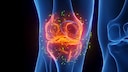 Beg&uuml;nstigt Alkohol die Entstehung von Arthrose?
