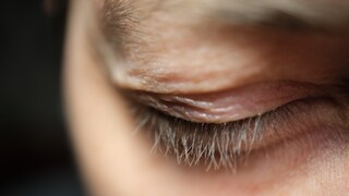 Schlupflider können u. a. Migräne begünstigen