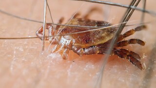 Zecken überfallen Jeden, beißen sich überall fest und können für Krankheiten sorgen