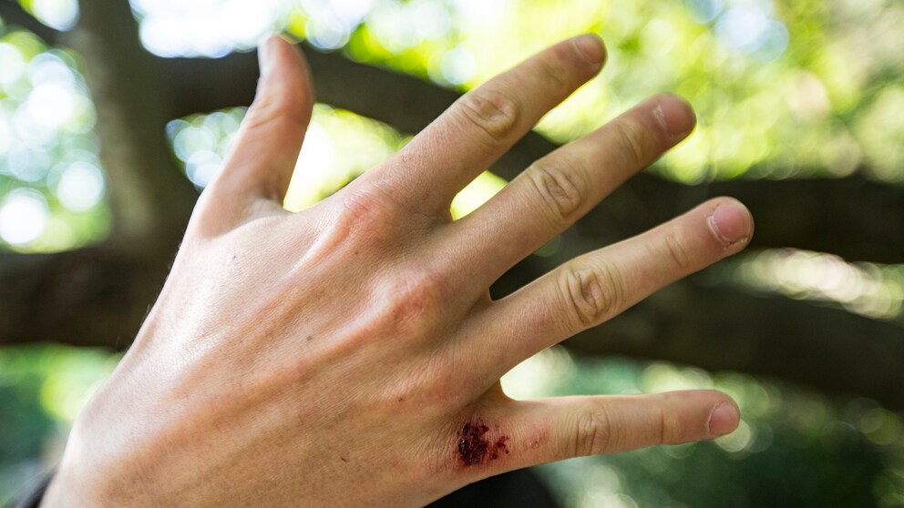 Garten Infektion: Eine Hand mit einer Wunde am kleinen Finger