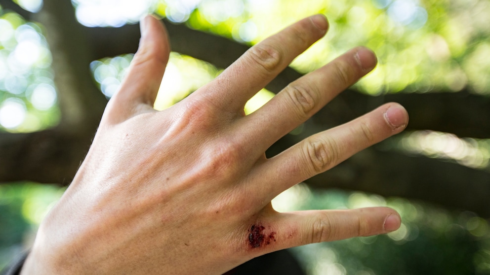 Garten Infektion: Eine Hand mit einer Wunde am kleinen Finger