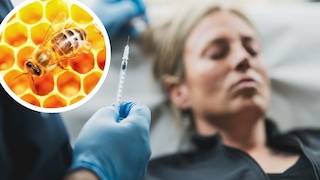 Collae aus Honigbiene auf Wabe und Faltenbehandlung mit Hyaluronsäure (Symbolbild)
