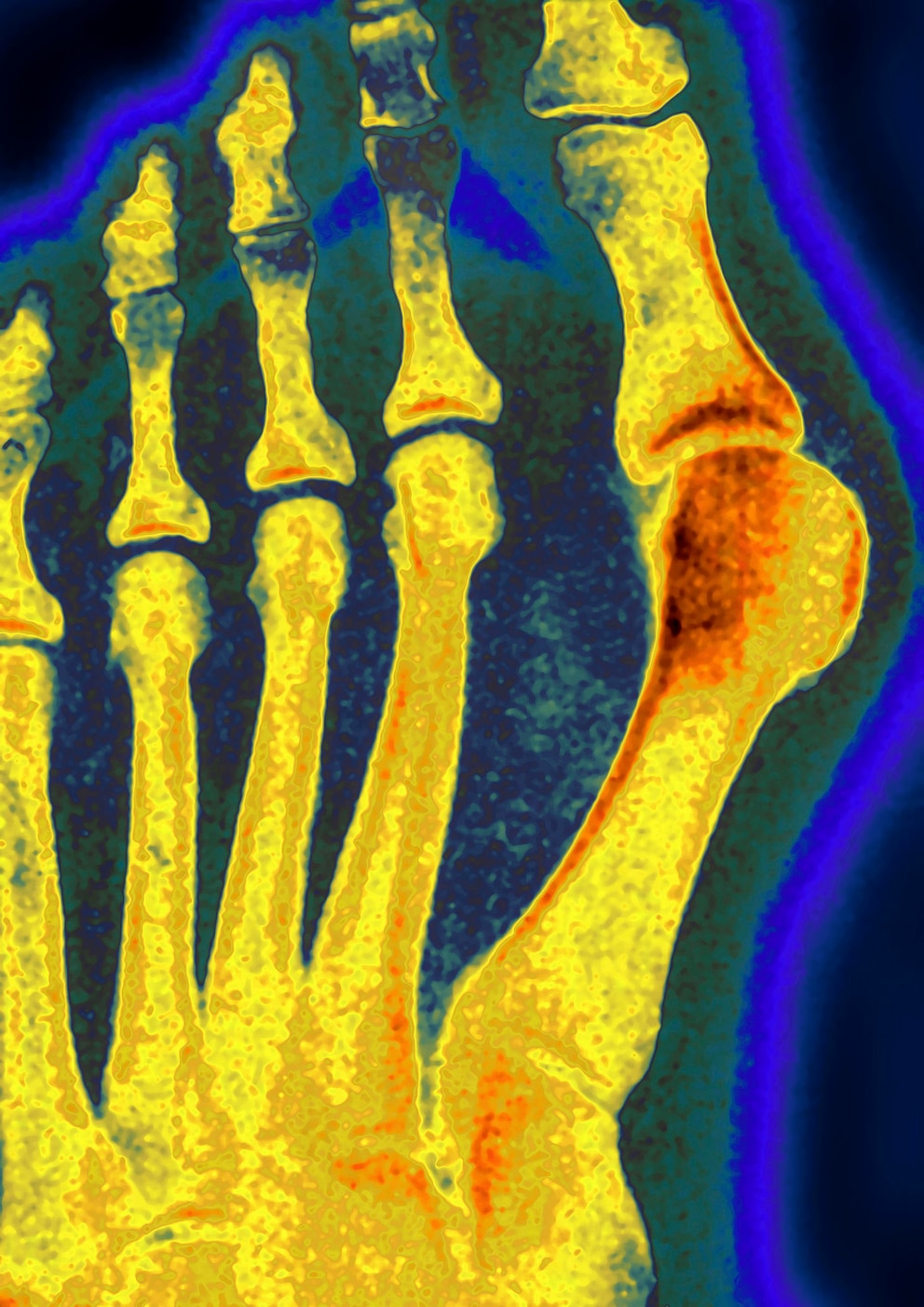 Hallux valgus auf Röntgenbild