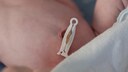 Baby mit abgeklemmter Nabelschnur